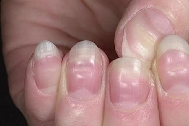 Диагностика состояния здоровья по внешнему виду ногтей Цвет здоровых ногтей